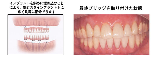 Cvg΂߂ɖߍނƂɂ肩ޗ͂CvgɍLϓɔzł܂
