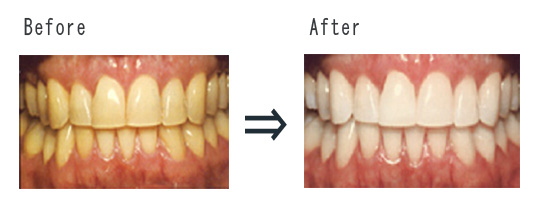 before after