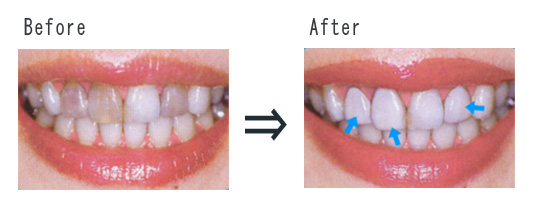 before after